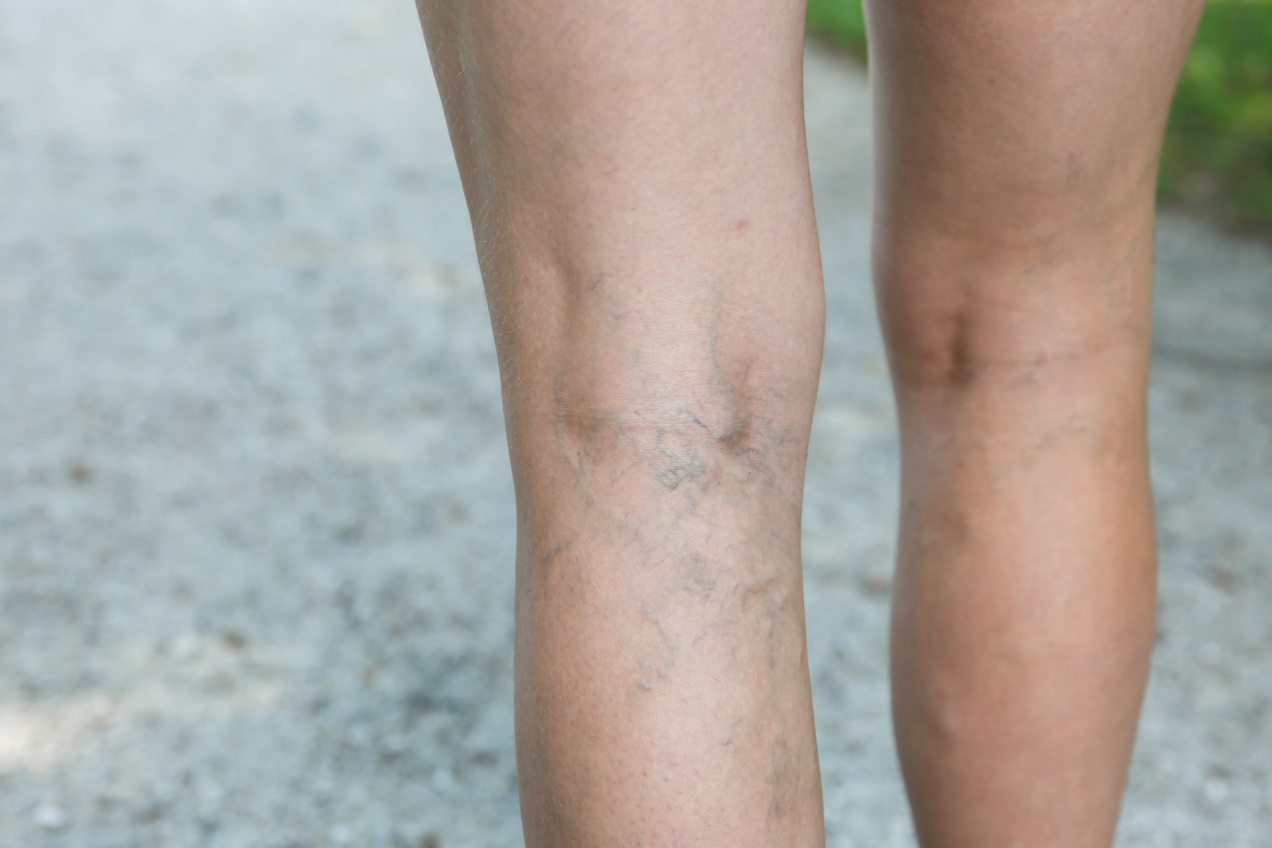 Information About Varicose Veins Health Beat