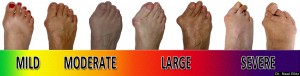 Bunion_Progression_Scale