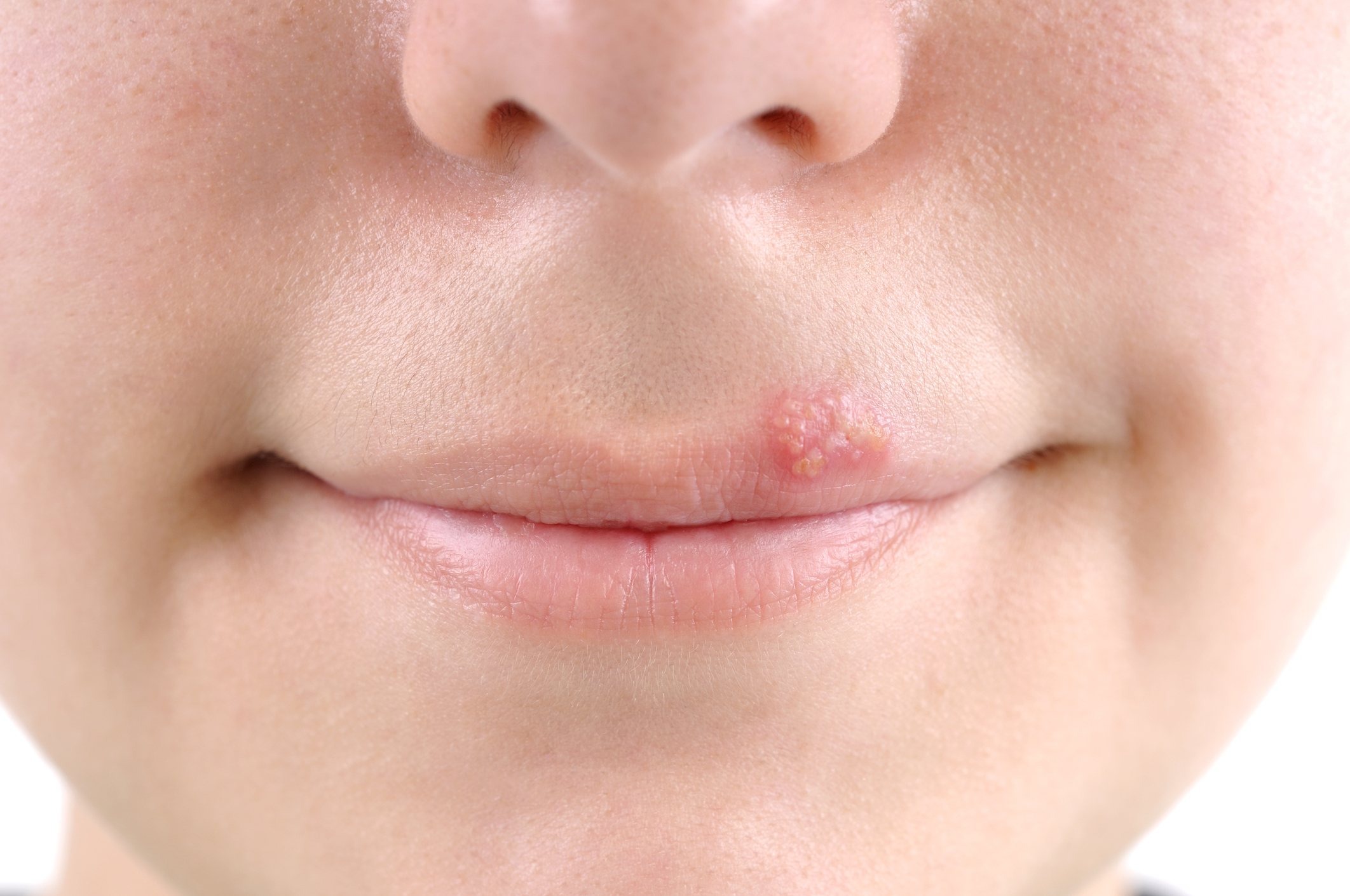 Jamaica Hospital Offers Facts About Cold Sores   Health BeatHealth ...