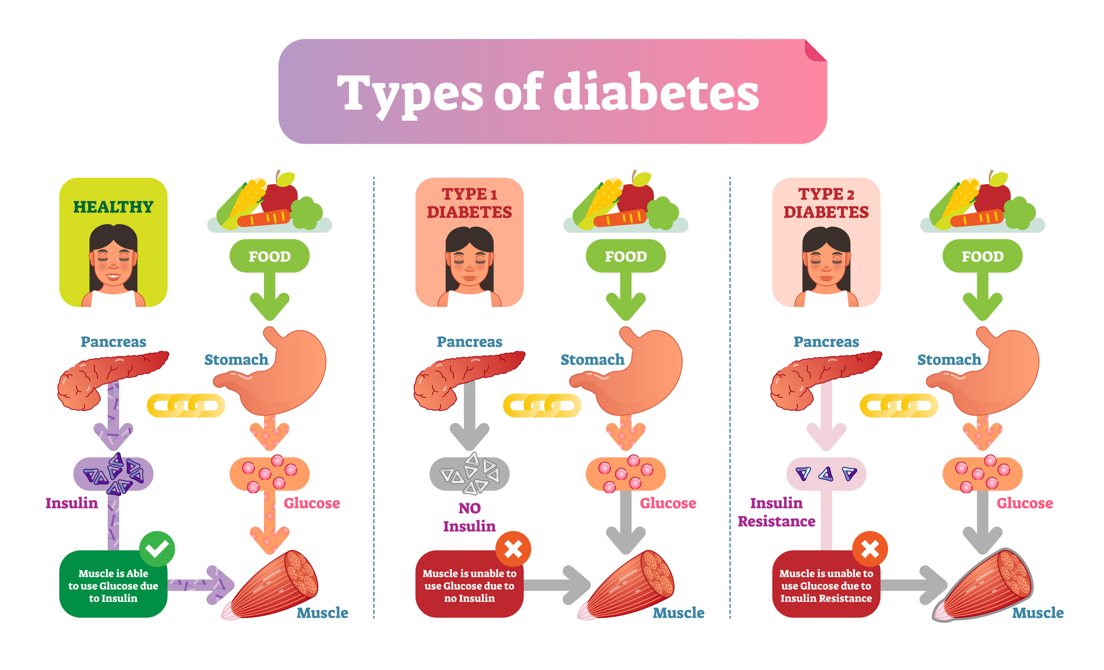 Type 2 Diabetes Diagram Comparing Healthy And Type 2 Diabetic