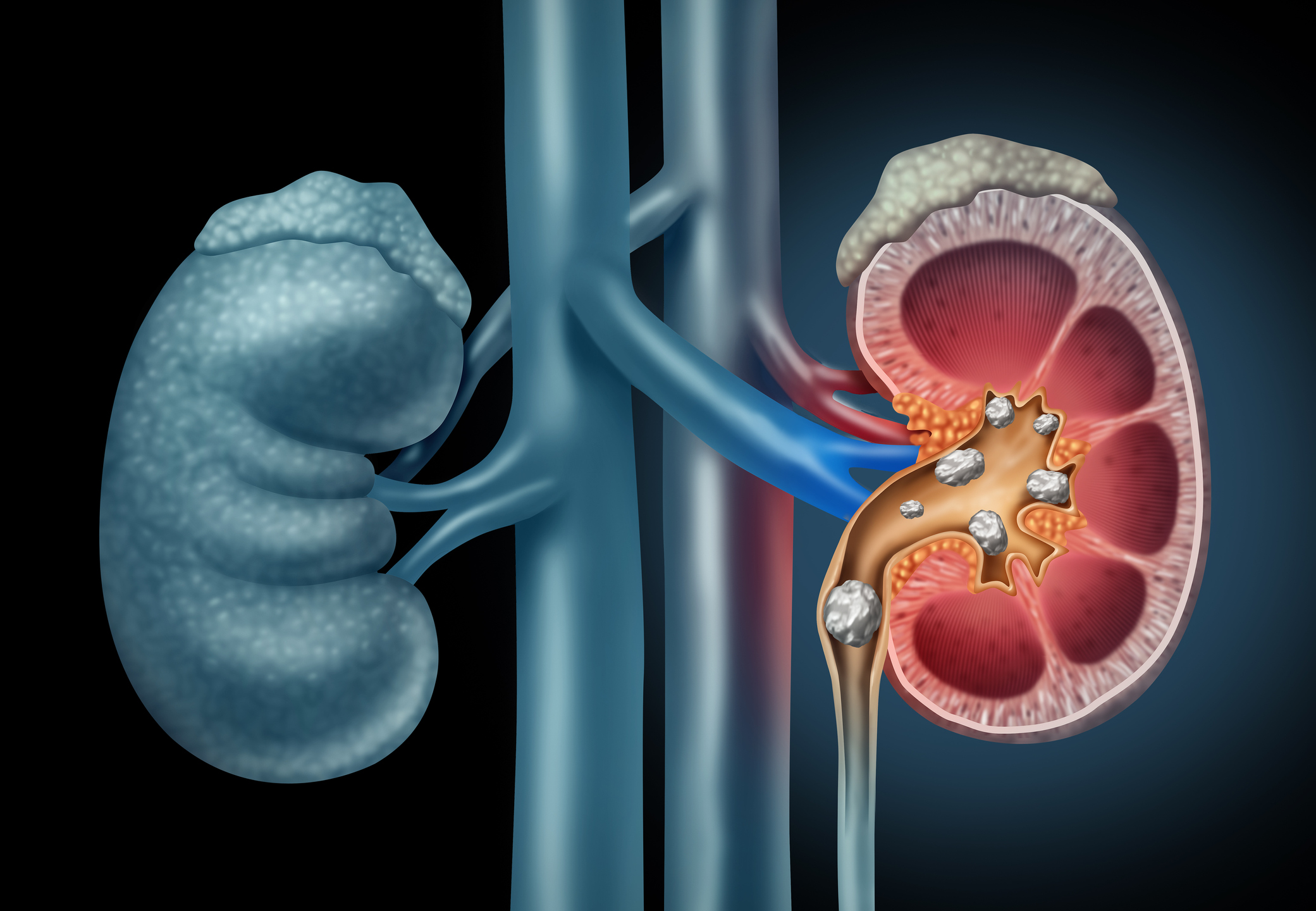 Human kidney Stones Medical Concept An illustration of kidney stones in the right kidney.